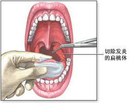 扁桃体结石之二 如何去除 青岛大学转化医学研究院